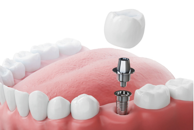 임플란트 재수술